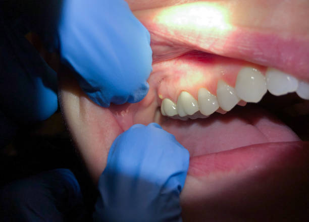 Best Emergency Treatment for Oral Infections in Savannah, GA